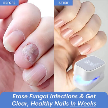 Sunbaz™ – Lasergerät gegen Nagelpilz